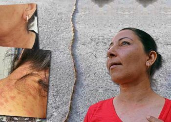 Evinin bahçesini temizledi, hastanelik oldu! Yüzü, boynu, gözleri ve kolları kızarıp kabardı