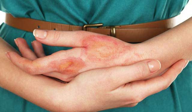 Yara izlerinin tamamen iyileşmesi mümkün müdür?